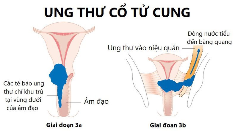 Triệu chứng ung thư cổ tử cung giai đoạn 3 và cách điều trị hiện nay