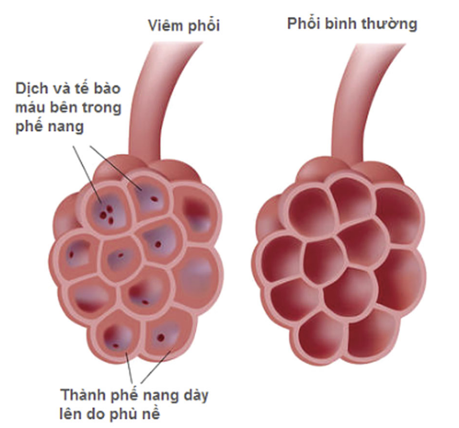 Viêm phổi ở trẻ sơ sinh