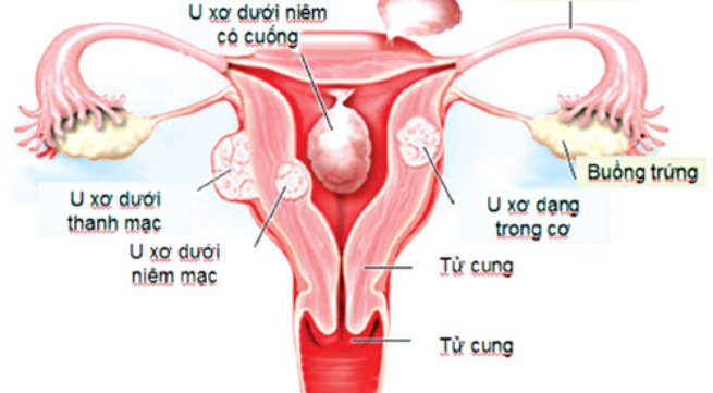 U xơ tử cung có nguy cơ chuyển thành ung thư không?