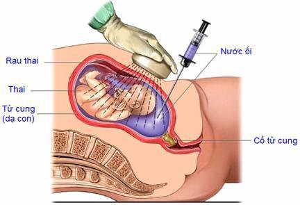 Đa ối khi mang thai - Cần làm gì để mẹ tròn con vuông