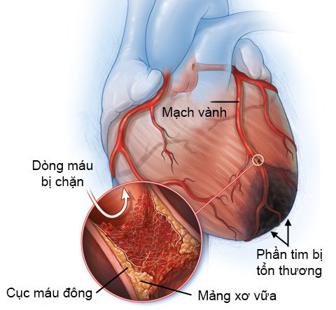Nhồi máu cơ tim