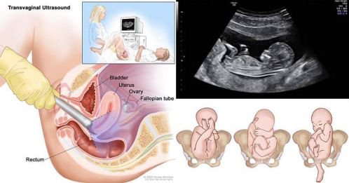Cổ tử cung ngắn có chắc chắn khiến phụ nữ sinh non không?