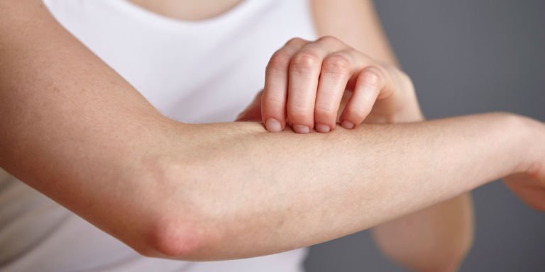 Sốt xuất huyết có tự khỏi không? Bệnh nhân có được tắm không?