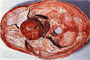 Khối u tuyến yên - Hình ảnh minh họa