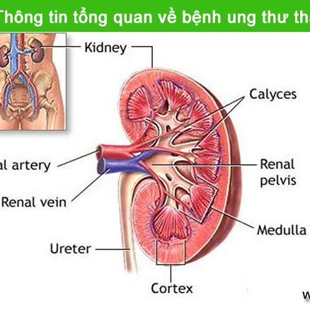 Kidney cancer - Hình ảnh minh họa