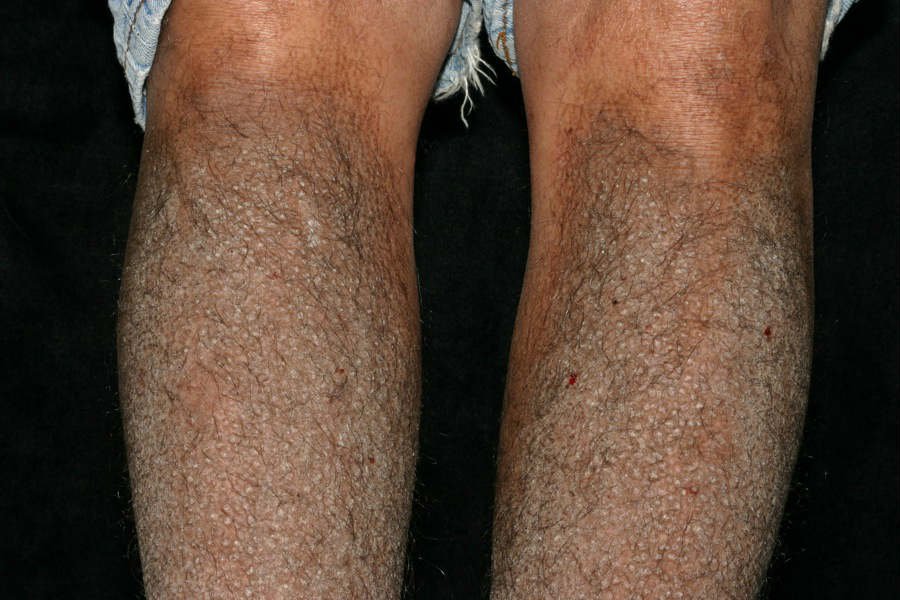 Amyloidosis - Hình ảnh minh họa