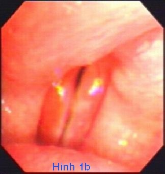 Liệt dây thanh - Hình ảnh minh họa