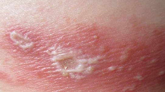 Kiến cắn - Hình ảnh minh họa