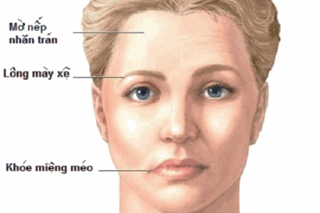 Liệt mặt ngoại biên - Hình ảnh minh họa