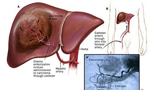 Khối u di căn - Hình ảnh minh họa