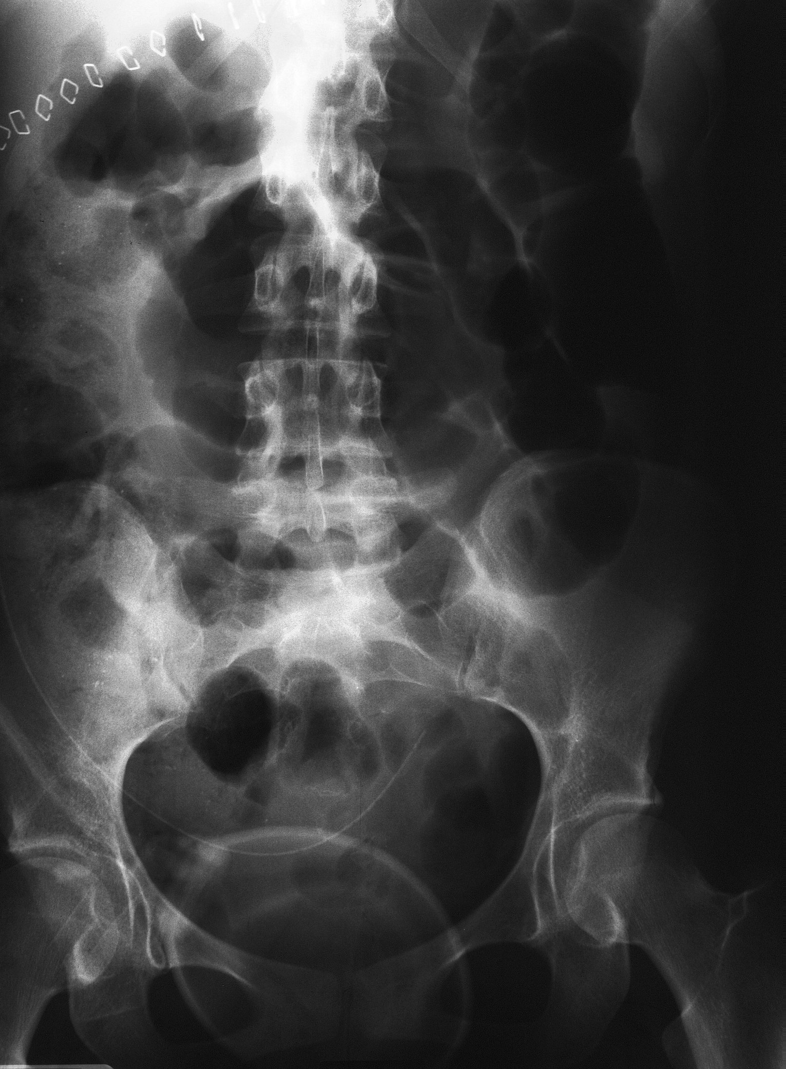 Liệt ruột - Hình ảnh minh họa