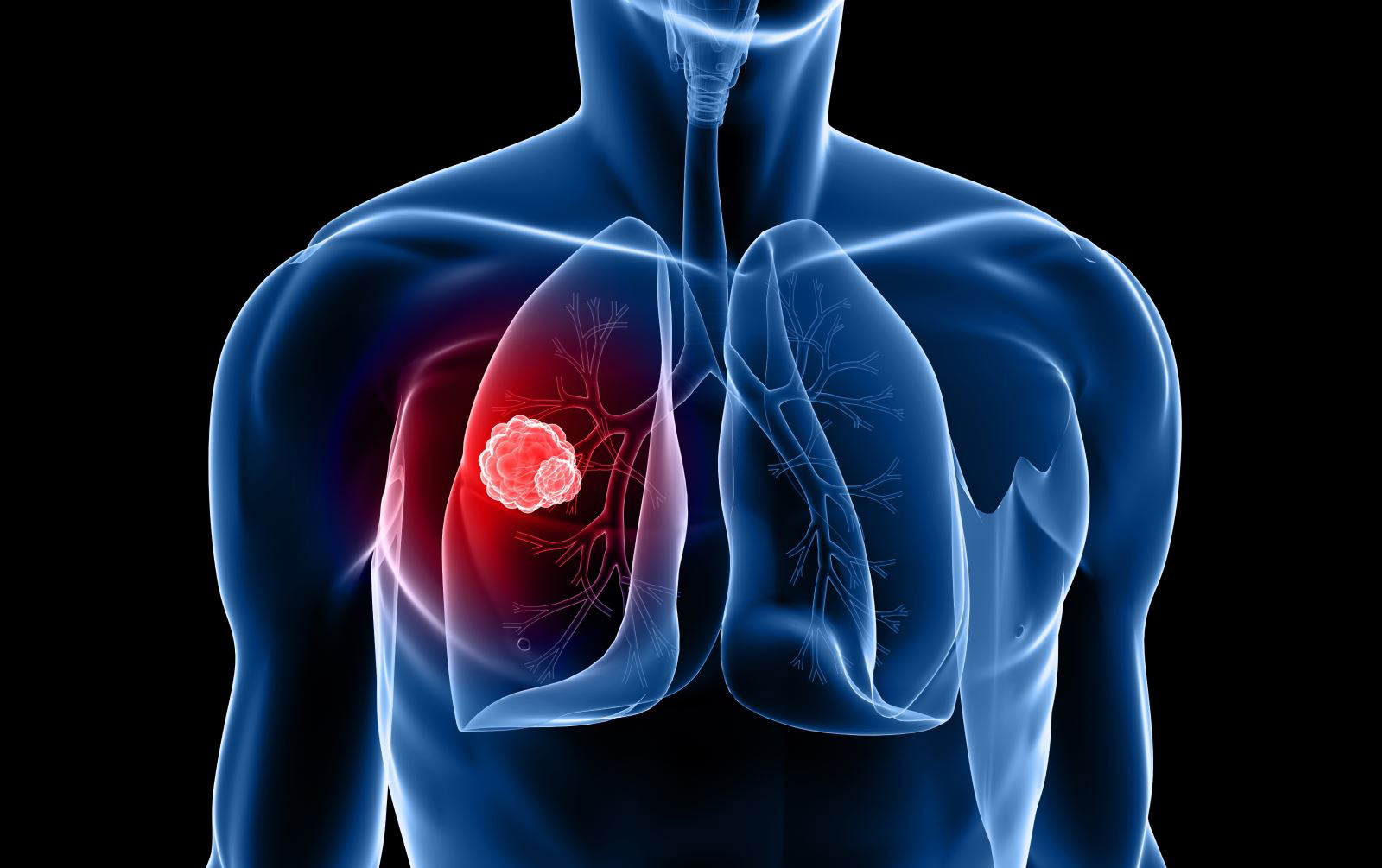 Lung cancer - Hình ảnh minh họa