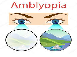 Amblyopia - Hình ảnh minh họa