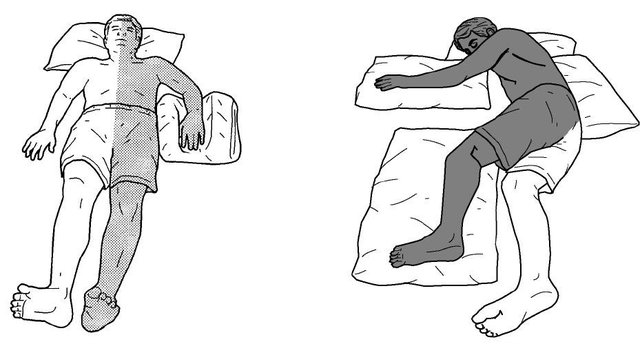 Liệt nửa người - Hình ảnh minh họa