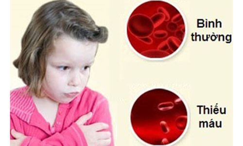 Anaemia - Hình ảnh minh họa