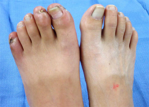 Loét bàn chân - Hình ảnh minh họa