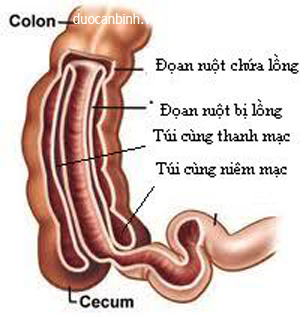 Lồng ruột - Hình ảnh minh họa