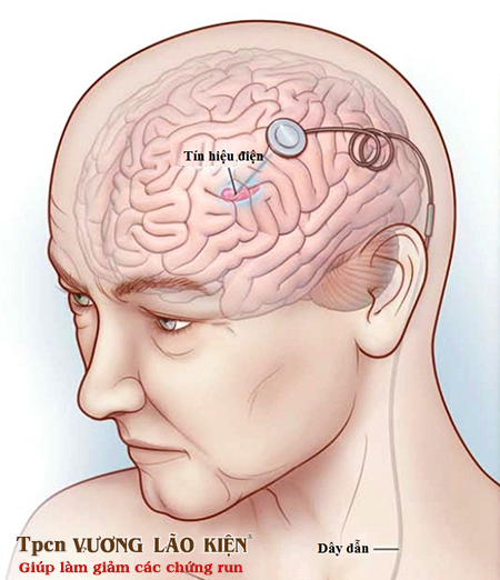 Loạn trương lực cơ - Hình ảnh minh họa
