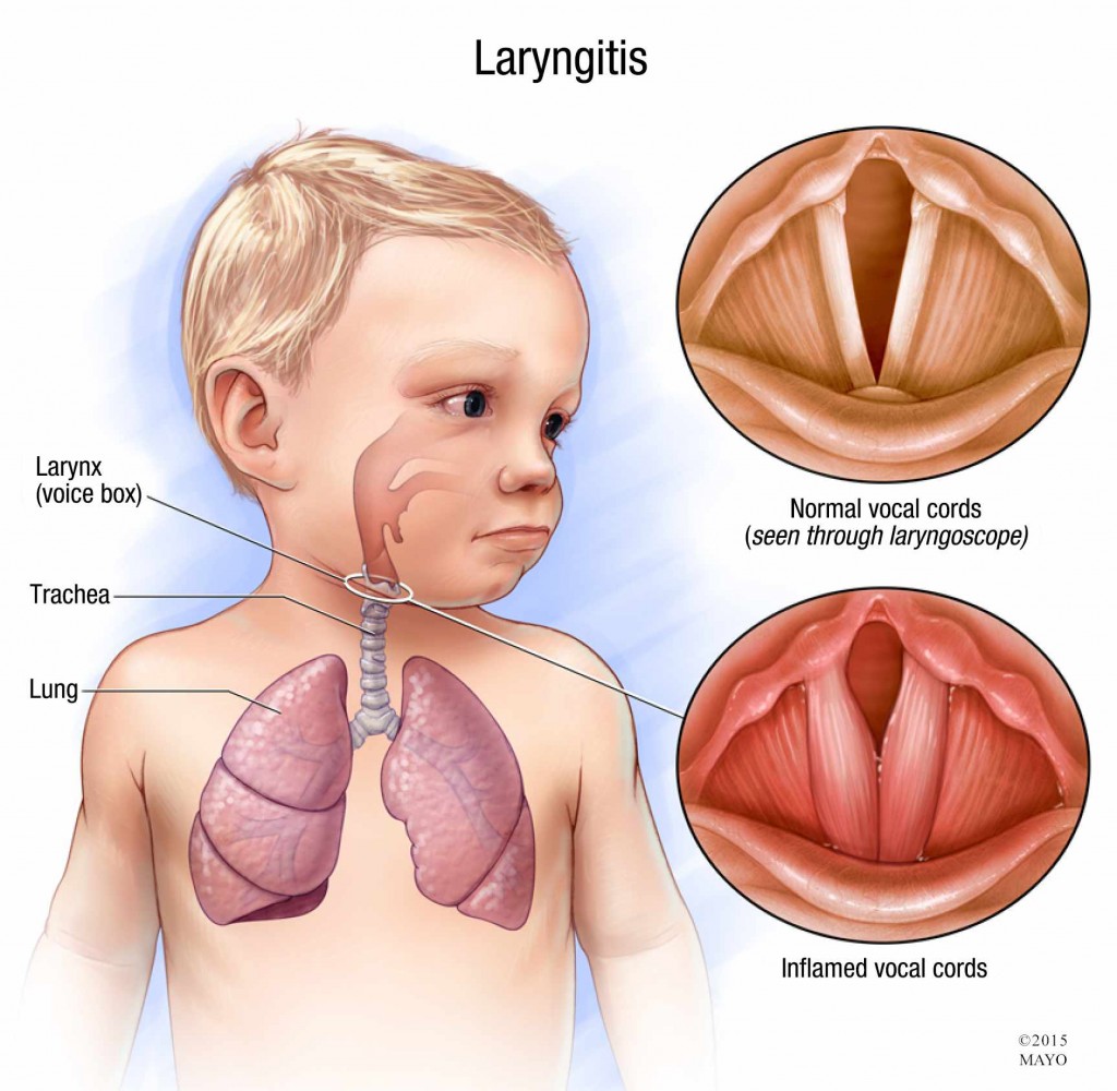 Laryngitis - Hình ảnh minh họa