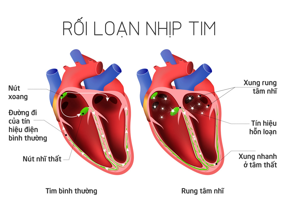 Loạn nhịp tim - Hình ảnh minh họa