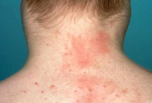 Lymphoma - Hình ảnh minh họa