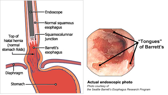 Lộn niêm mạc thực quản - Hình ảnh minh họa