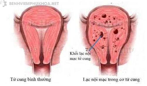 Adenomyosis - Hình ảnh minh họa