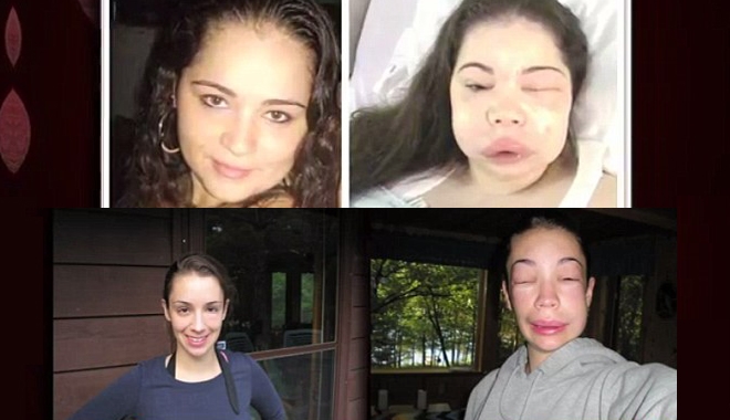 Angioedema - Hình ảnh minh họa