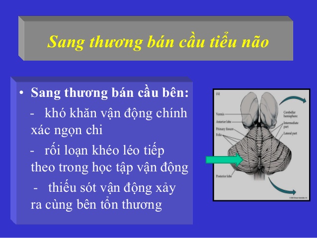 Ataxia - Hình ảnh minh họa