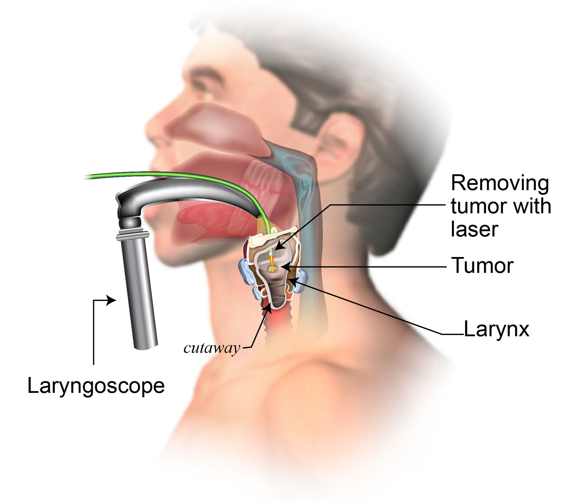 Larynx Cancer - Hình ảnh minh họa