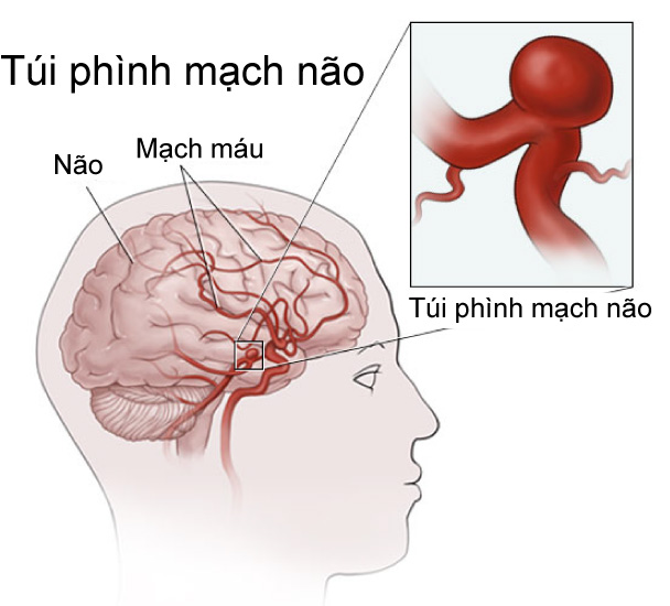Aneurysm - Hình ảnh minh họa