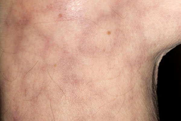 Livedo reticularis - Hình ảnh minh họa