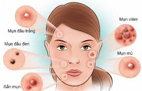 Lạm dụng Steroid - Hình ảnh minh họa