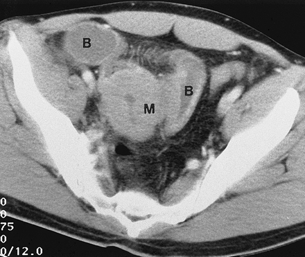 Lymphoma ruột non - Hình ảnh minh họa