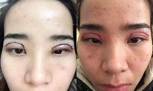 Liệt cơ mắt - Hình ảnh minh họa