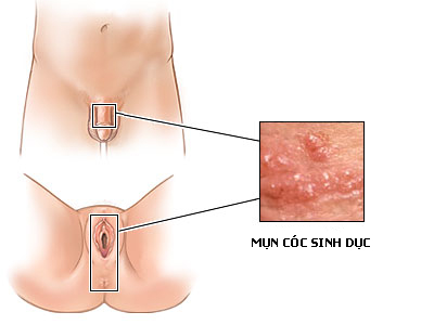 Acuminata condylomata - Hình ảnh minh họa