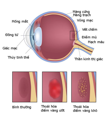 Age-related Macular Degeneration - Hình ảnh minh họa