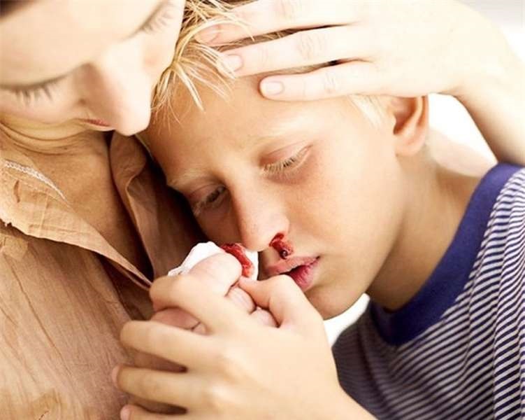 Acute myeloid leukemia (ALL) - Hình ảnh minh họa