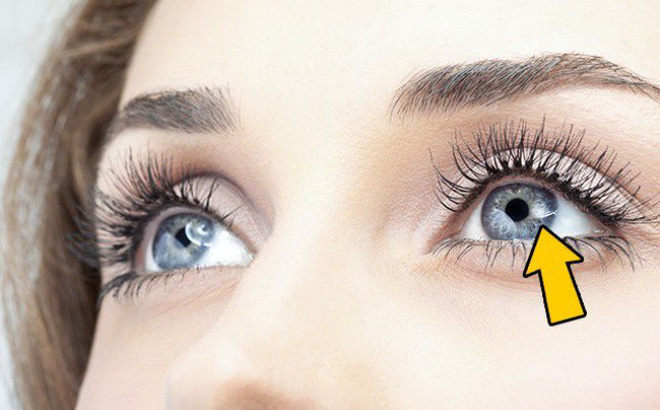 Mộng mắt - Trùng - Hình ảnh minh họa