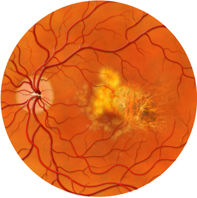 Mù đêm - Hình ảnh minh họa