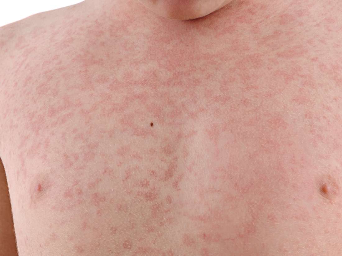 Measles - Hình ảnh minh họa