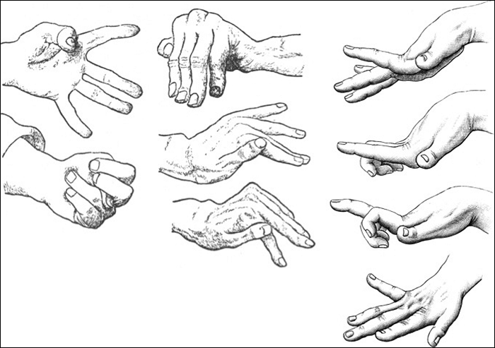 Múa giật (Huntington) - Hình ảnh minh họa