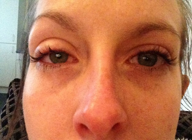 Mòn giác mạc - Hình ảnh minh họa