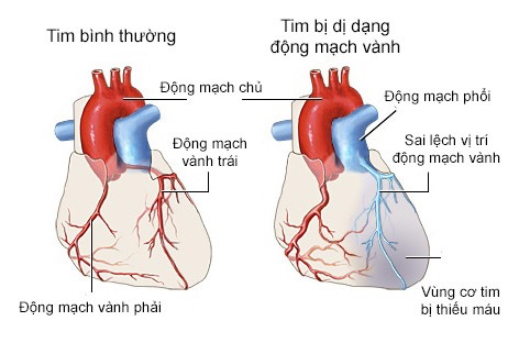 Mạch vành - Hình ảnh minh họa