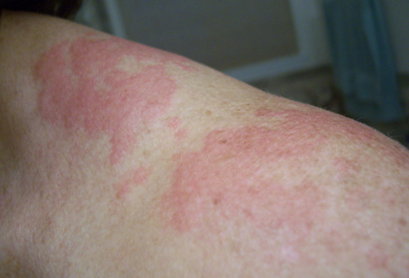 Mày đay - Hình ảnh minh họa