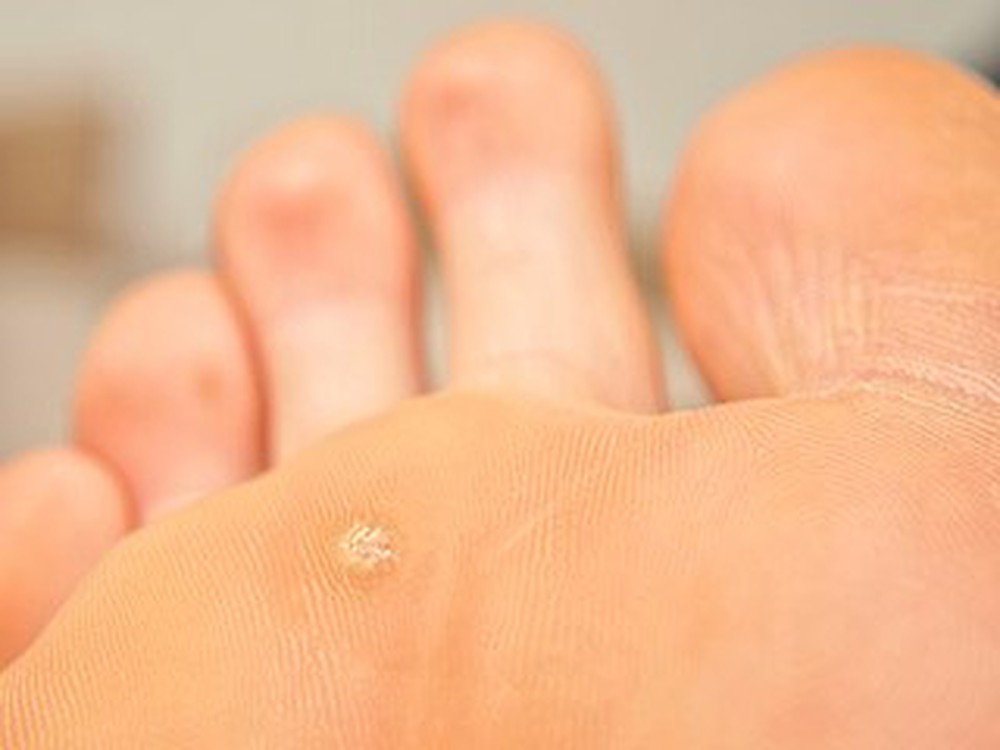 Mụn cóc ở bàn chân - Hình ảnh minh họa