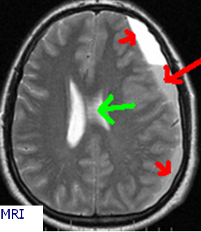 Máu tụ dưới màng cứng - Hình ảnh minh họa