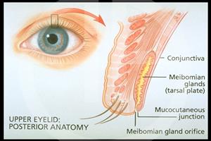 Meibomian Gland - Hình ảnh minh họa