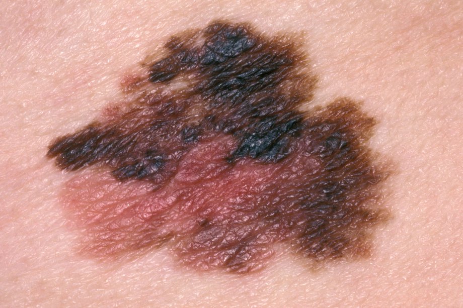Malignant melanoma - Hình ảnh minh họa