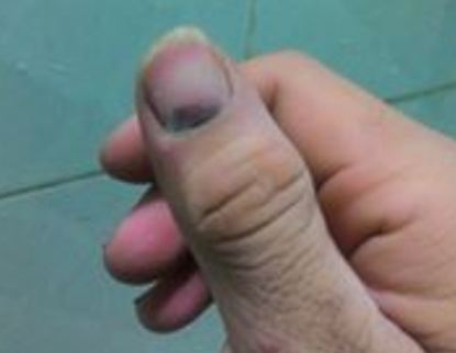 Máu bầm ở móng tay - Hình ảnh minh họa